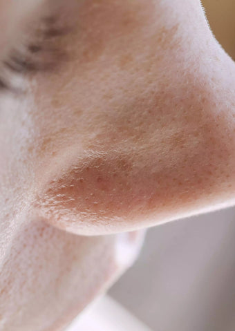 Congested Pores